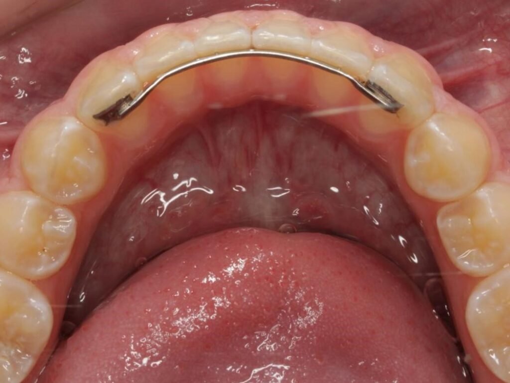 Intraoral scanner capturing a digital 3D scan of a patient's teeth during a dental examination.