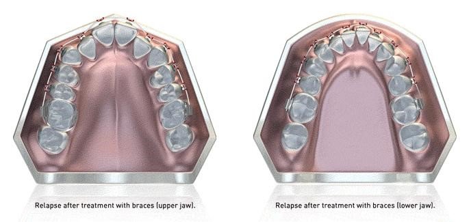 Comparison of traditional dental impressions and digital 3D orthodontic models used for treatment planning.