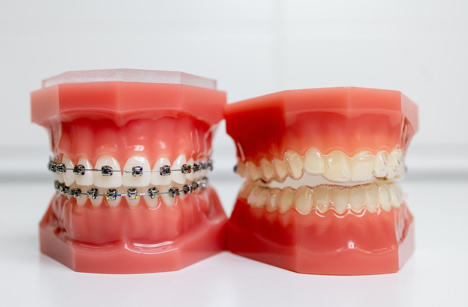 Dental model with braces demonstrating how orthodontic appliances are positioned on the teeth.