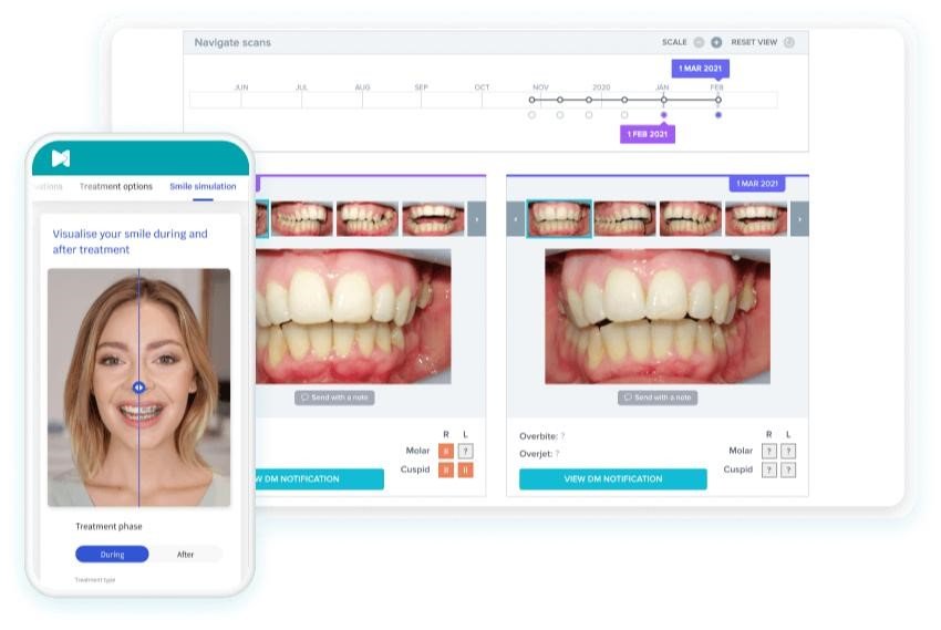 Digital orthodontic software displaying before-and-after treatment records during a patient consultation.
