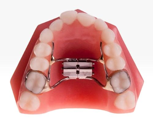 Palatal expander positioned on the upper teeth to illustrate an orthodontic expansion appliance.