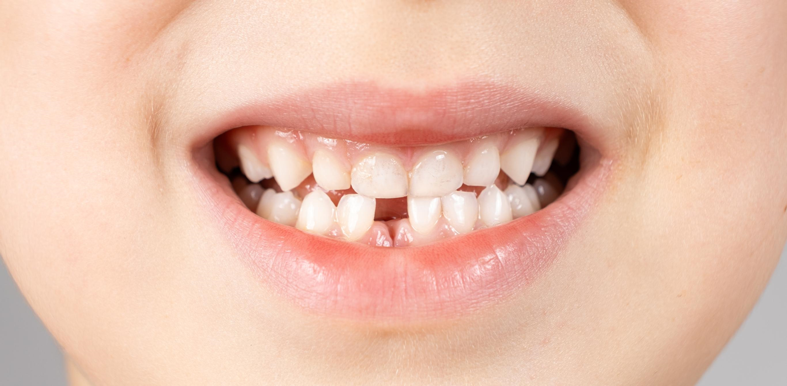 Close-up of a child's developing teeth during the transition from baby teeth to permanent teeth.