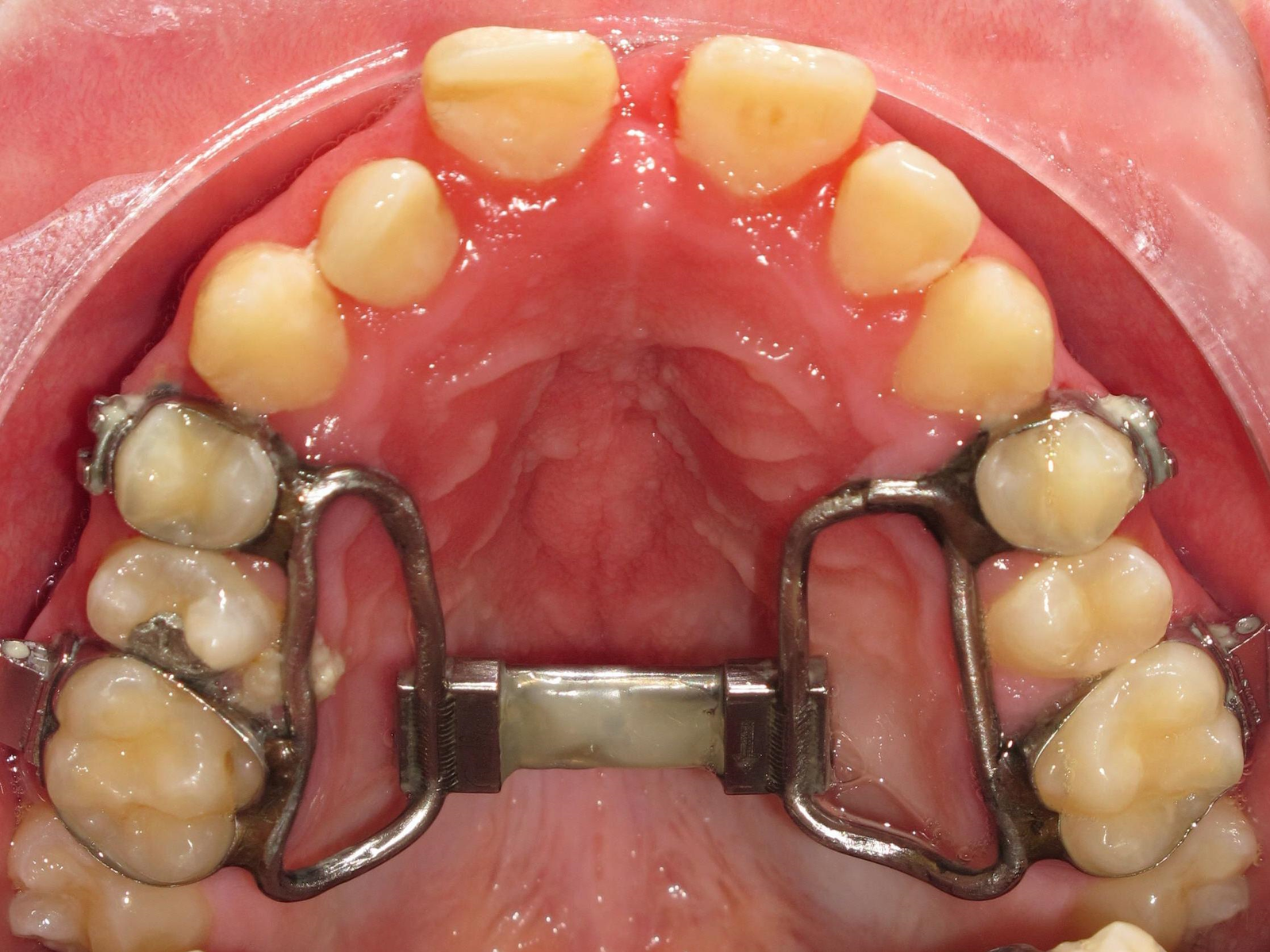 Orthodontic expander positioned across the upper dental arch.