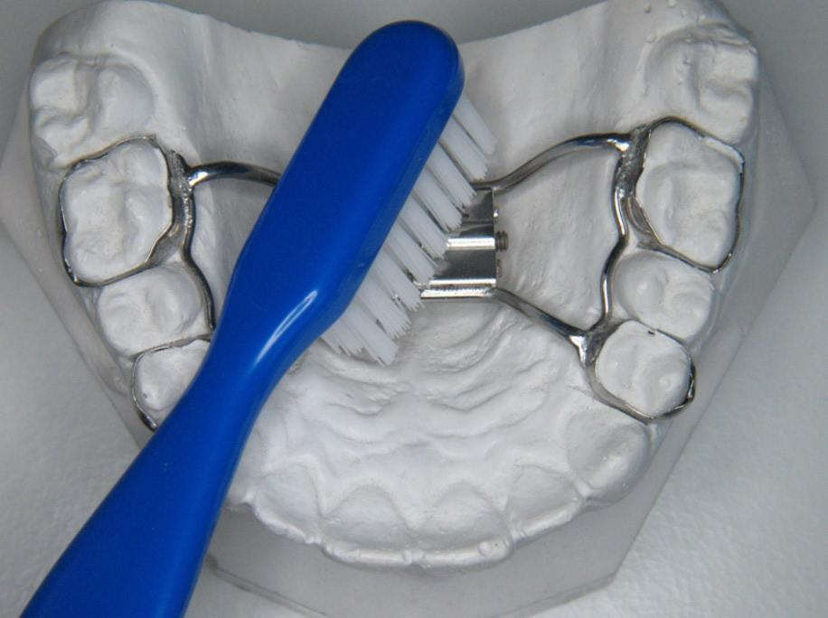 Dental model demonstrating cleaning around an orthodontic expander with a toothbrush.