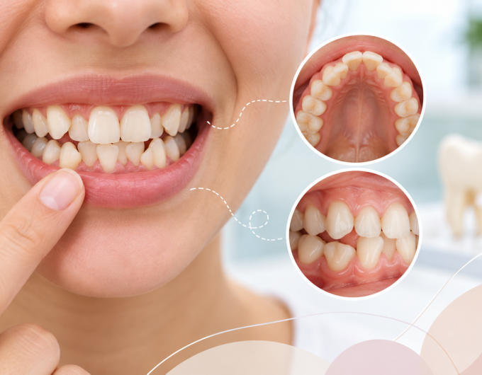 Crowded teeth showing overlapping and misaligned teeth