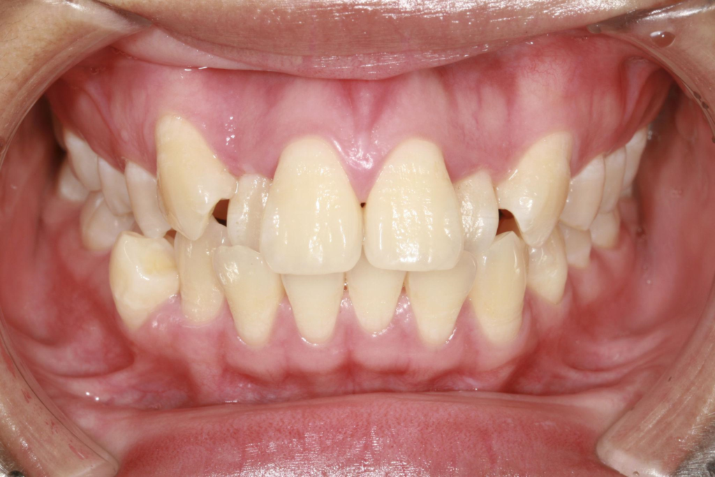Crooked and crowded teeth before orthodontic treatment