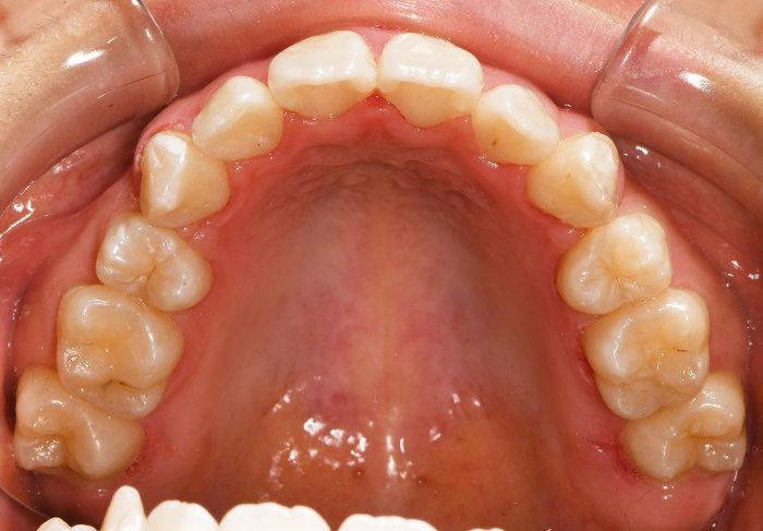 Upper teeth showing crowding and misalignment