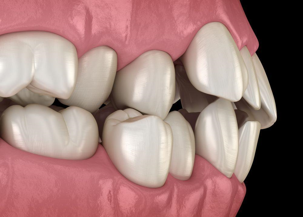 Side view of crooked teeth and dental misalignment