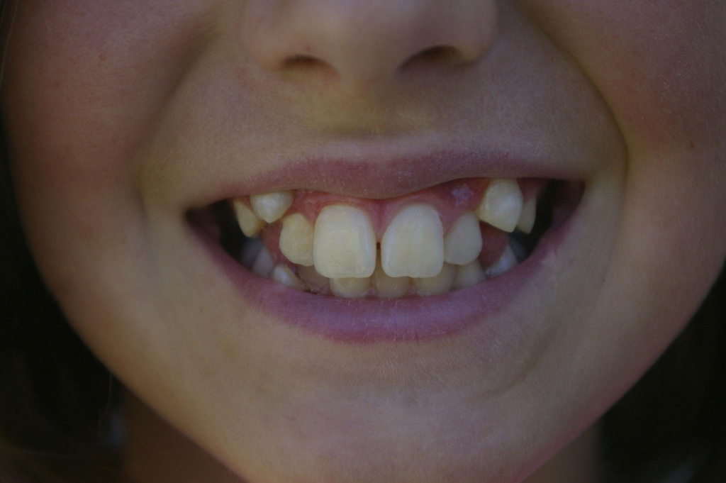 Smile showing crooked and misaligned front teeth